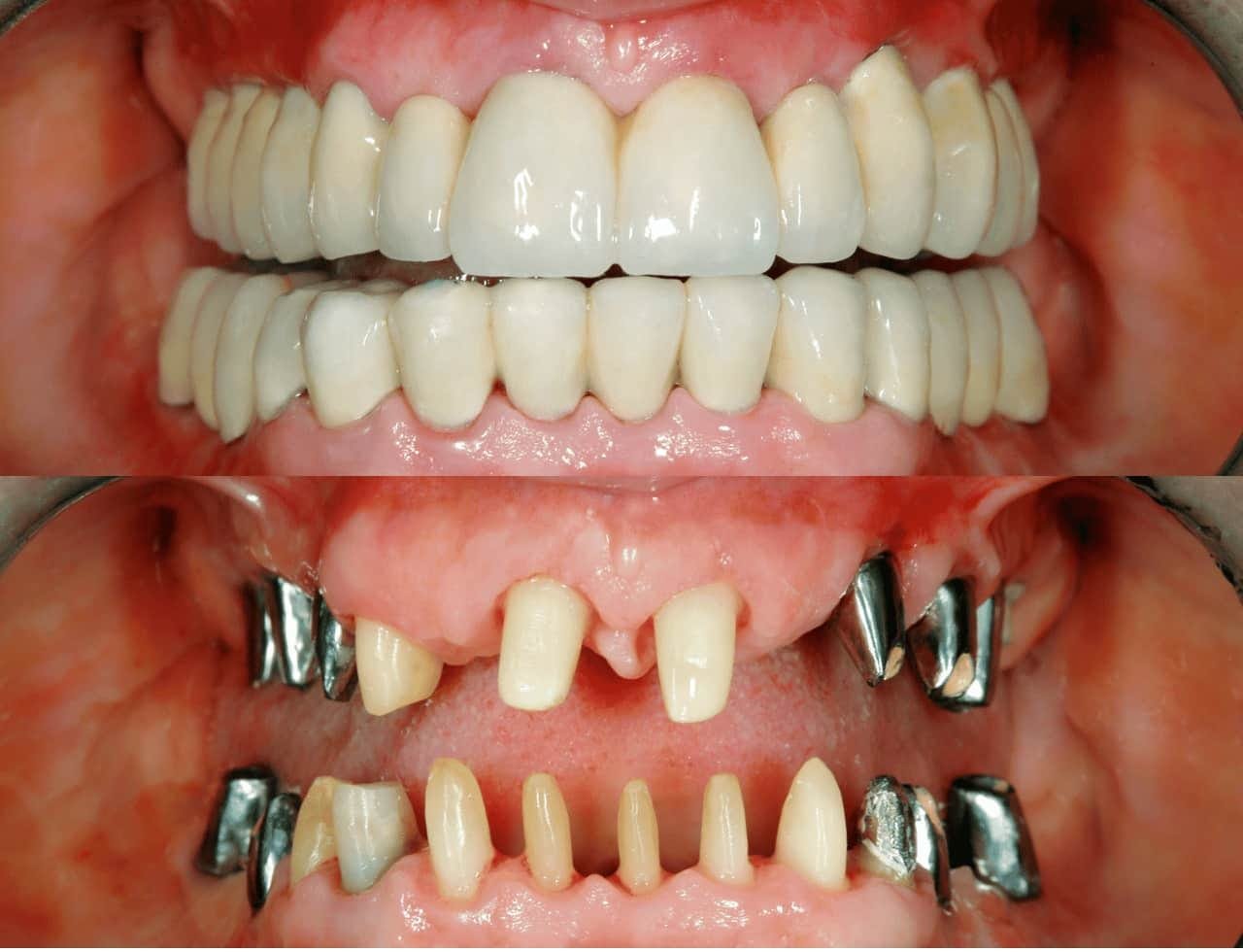 Full Mouth Rehabilitation Result